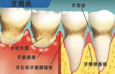 牙肉和牙床骨收縮