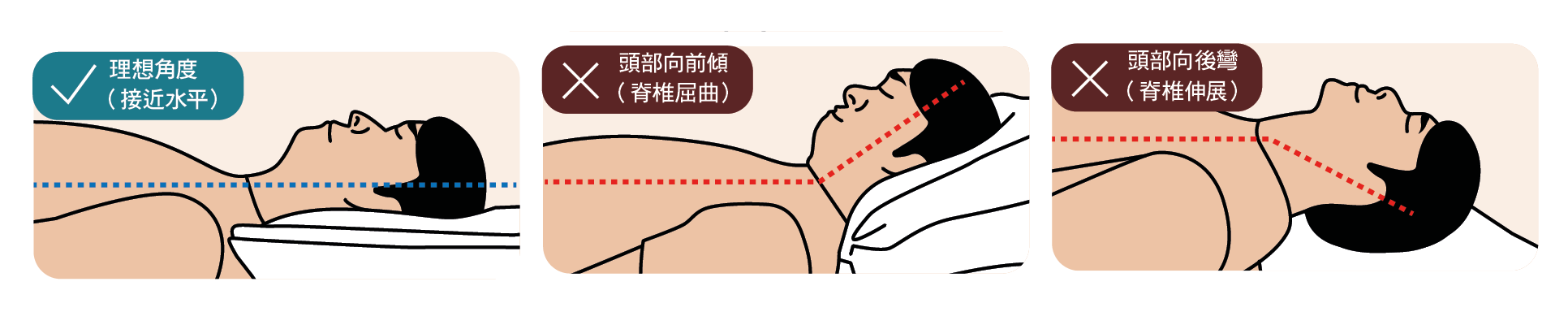 圖3:仰臥時的頭部角度