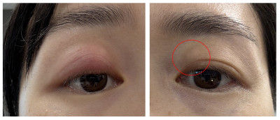 圖中女士右眼先出現麥粒腫，痊癒不久後，左眼又出霰粒腫。